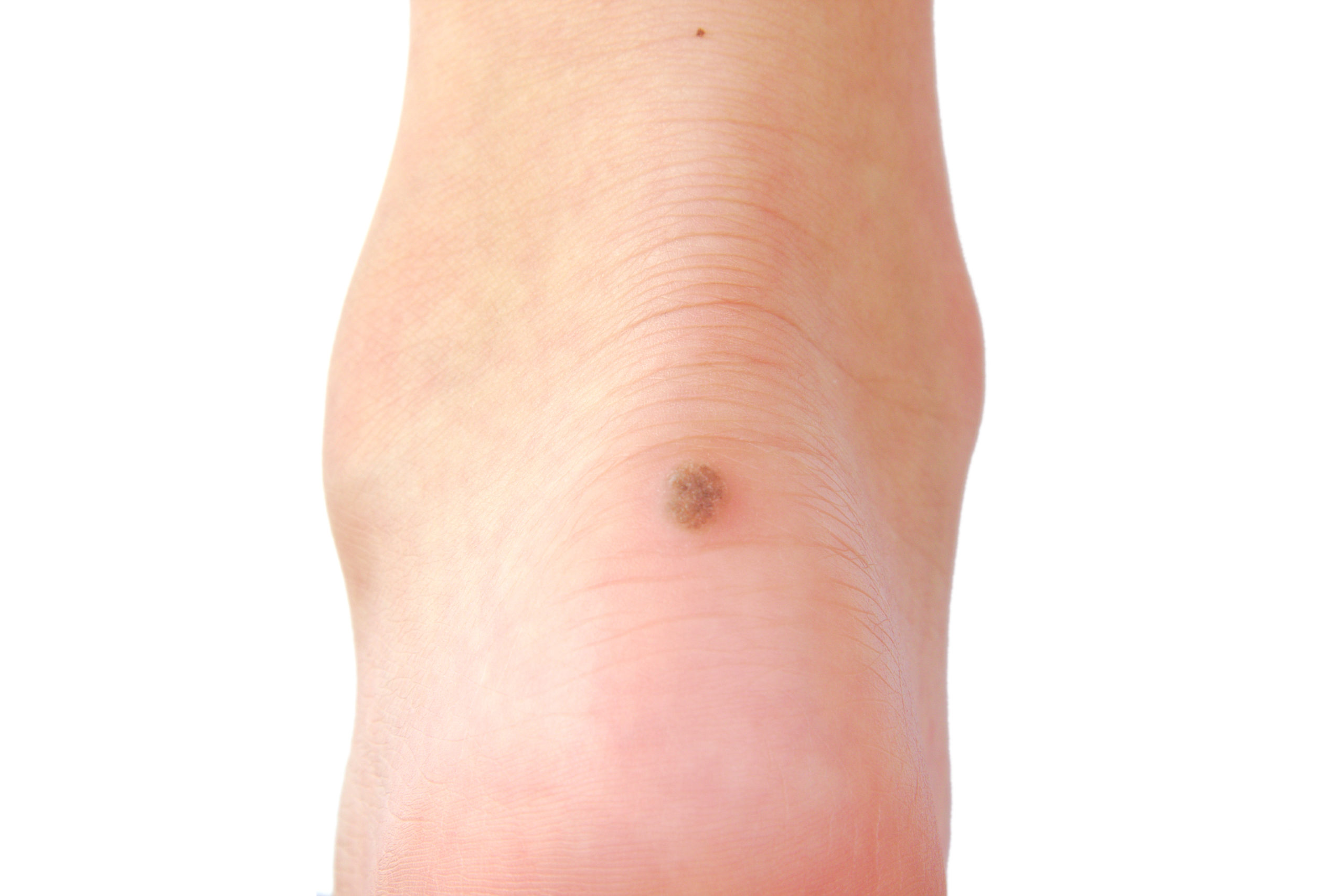 Allen Taintor Dermatology Ogden UT Wart Removal