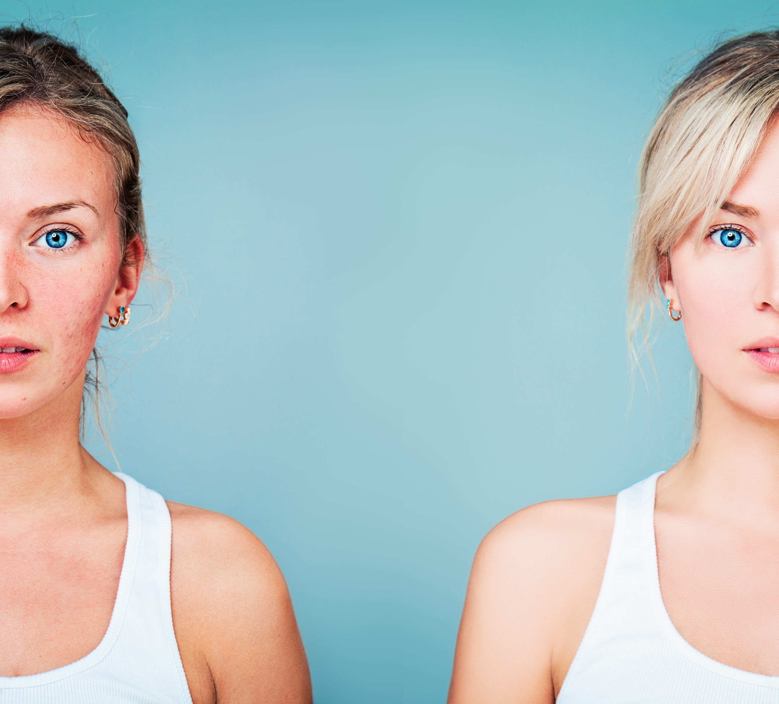 Rosacea Treatment Ogden UT Allen Taintor Dermatology