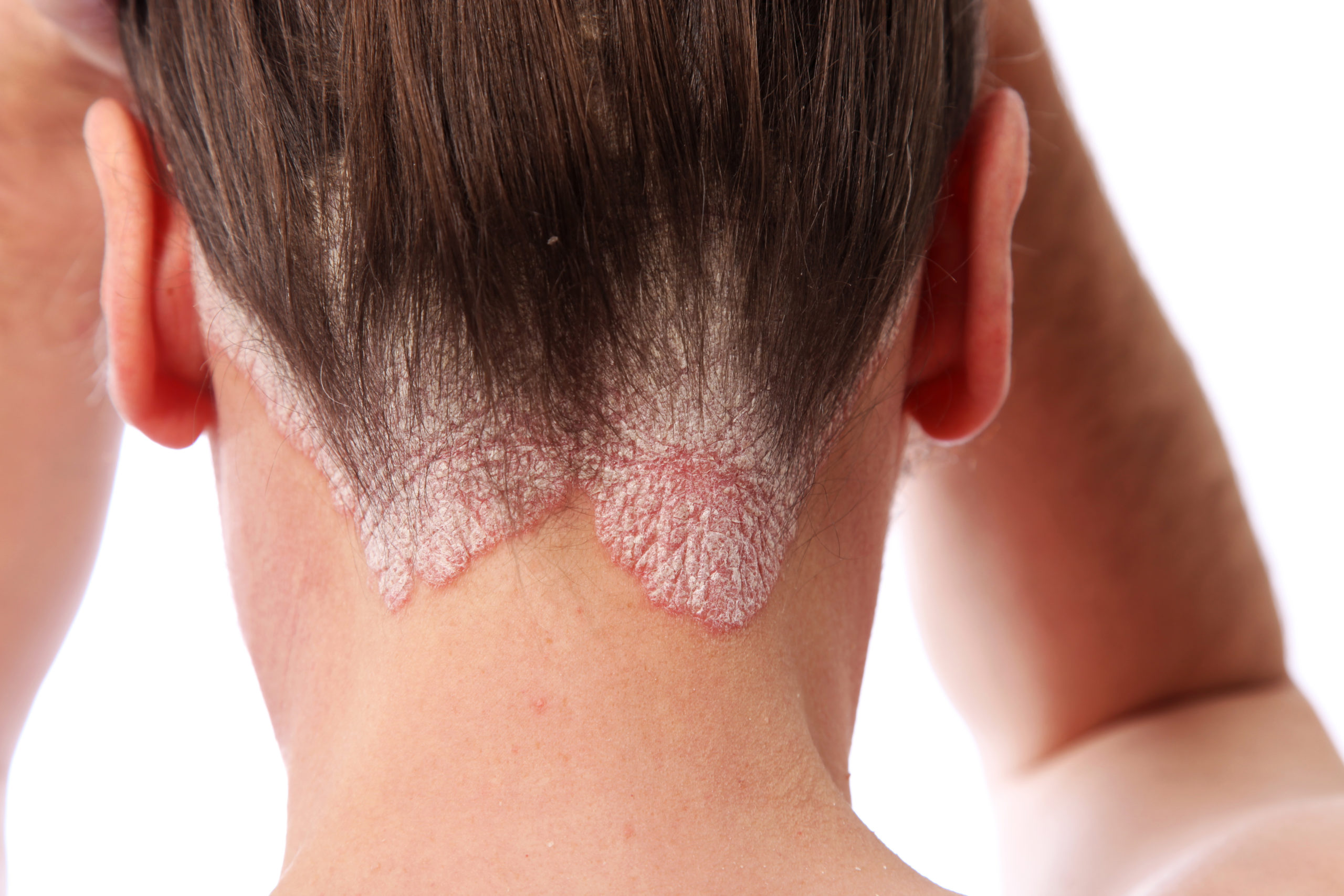 Allen Taintor Dermatology treating psoriasis Ogden Utah Dermatologist
