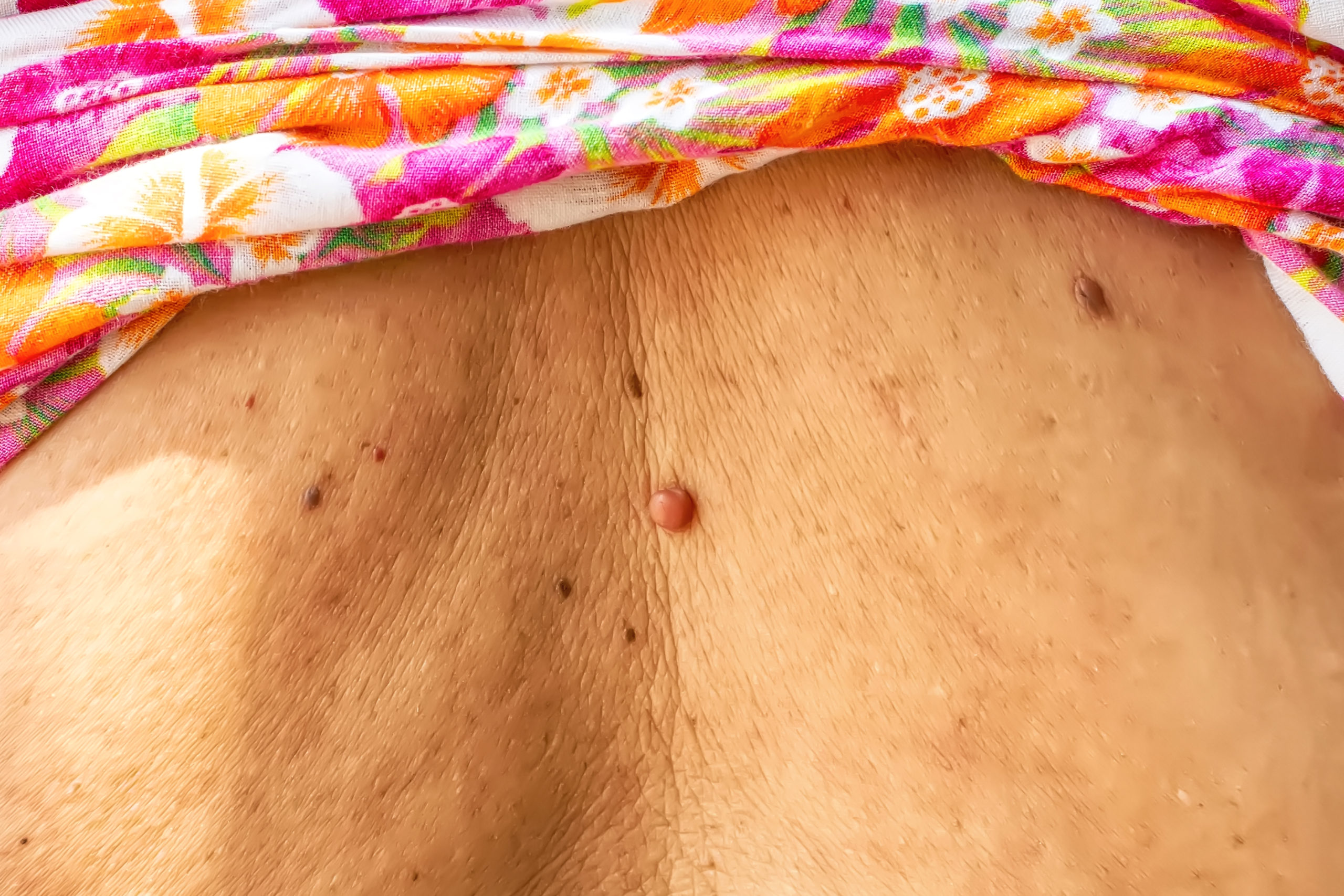 skin tags Allen Taintor Dermatology