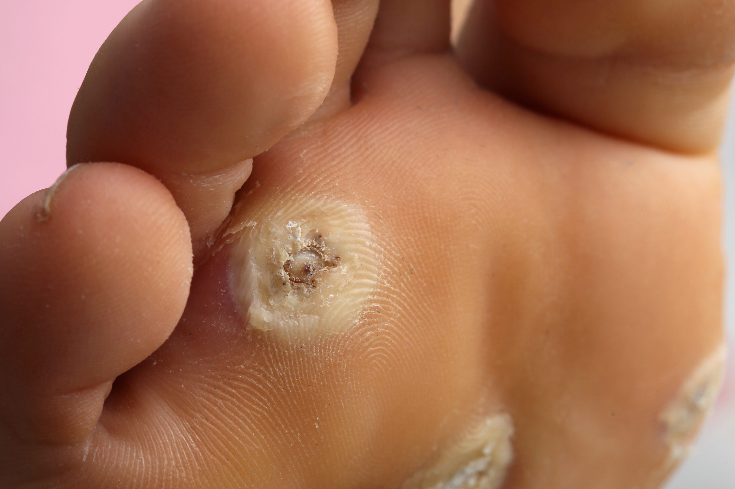 salicylic acid plantar warts