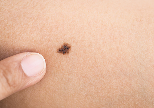 Allen Taintor Dermatology Ogden UT Signs of Skin Cancer