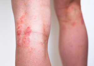Eczema Treatment Ogden Utah Allen-Taintor Dermatology