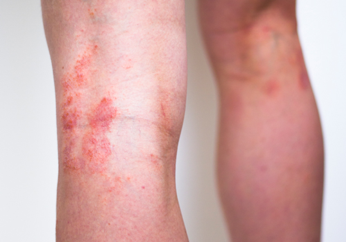 Eczema Treatment Ogden Utah Allen Taintor Dermatology