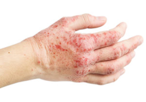 Allen-Taintor Dermatology Eczema Treatment Ogden Utah