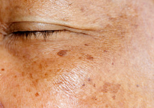 Melanoma Skin Cancer Ogden Allen-Taintor Dermatology