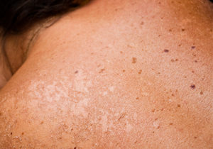 Allen-Taintor Dermatology Ogden Melanoma Skin Cancer