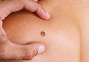 Skin Cancer Skin Cancer Ogden Allen-Taintor Dermatology