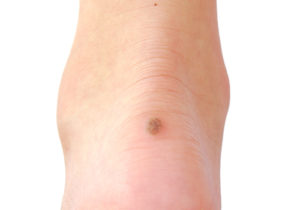 Warts Removal Ogden Utah Allen-Taintor Dermatology