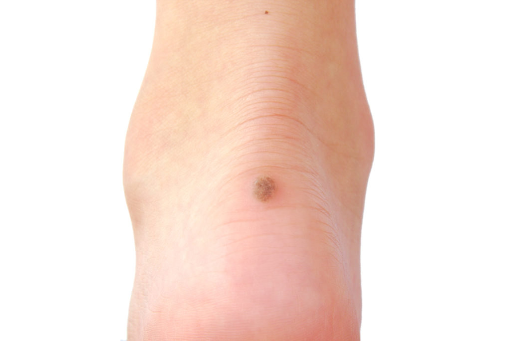 What Causes Warts? AllenTaintor Dermatology