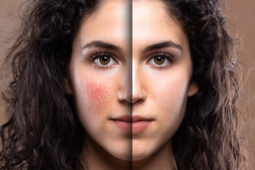 dealing with rosacea