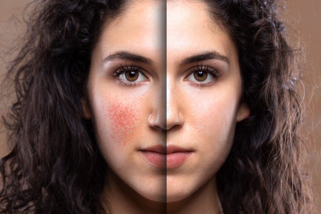 Allen Taintor Dermatology dealing with rosacea