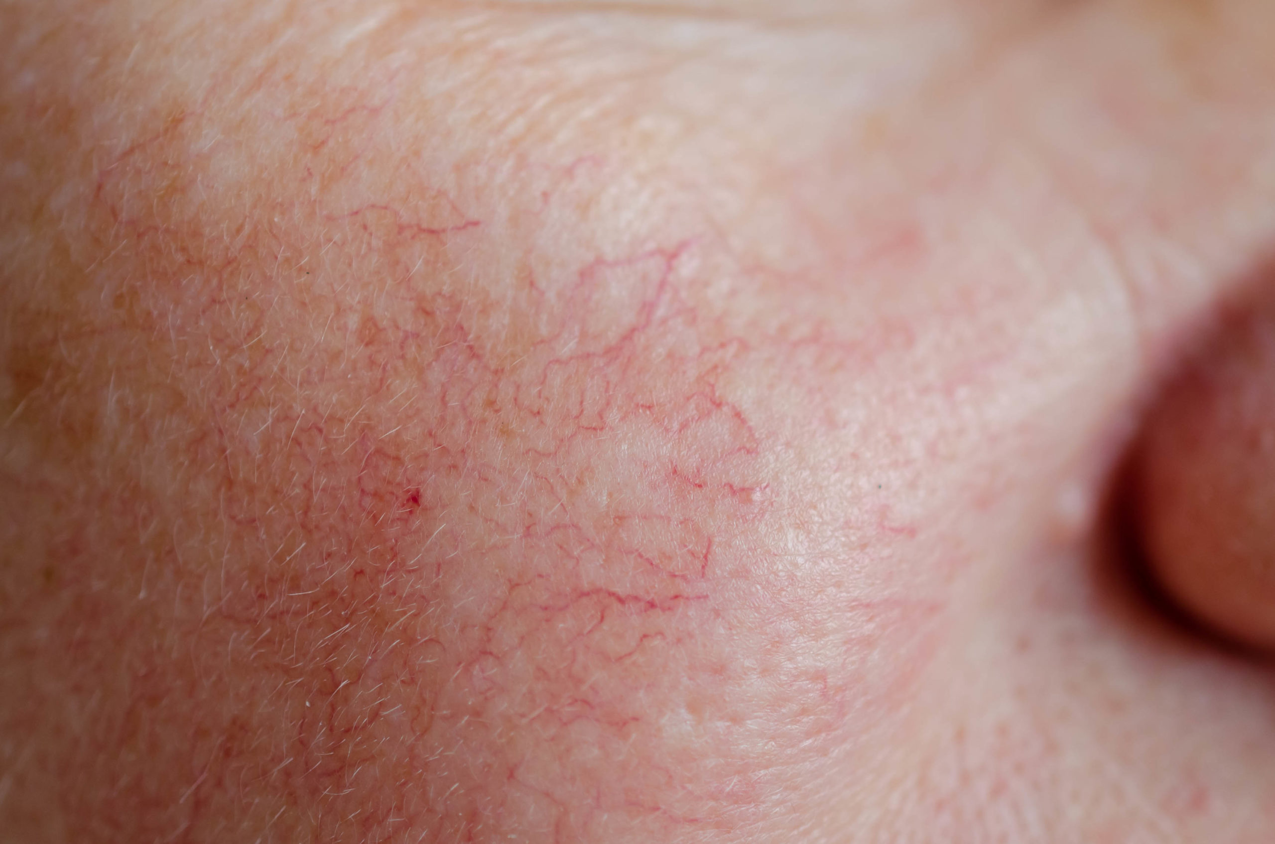 dealing with rosacea Allen Taintor Dermatology