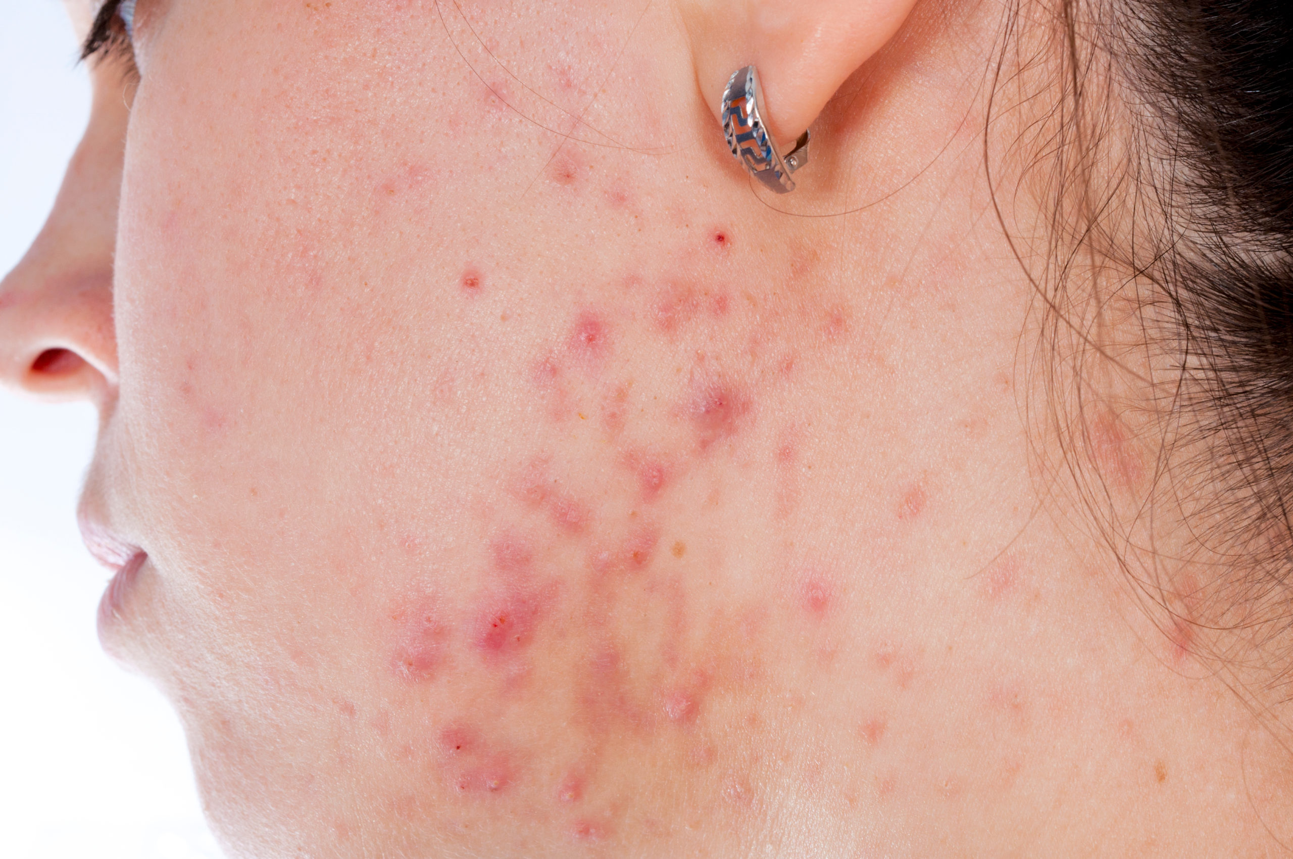 acne vs rosacea Allen Taintor Dermatology