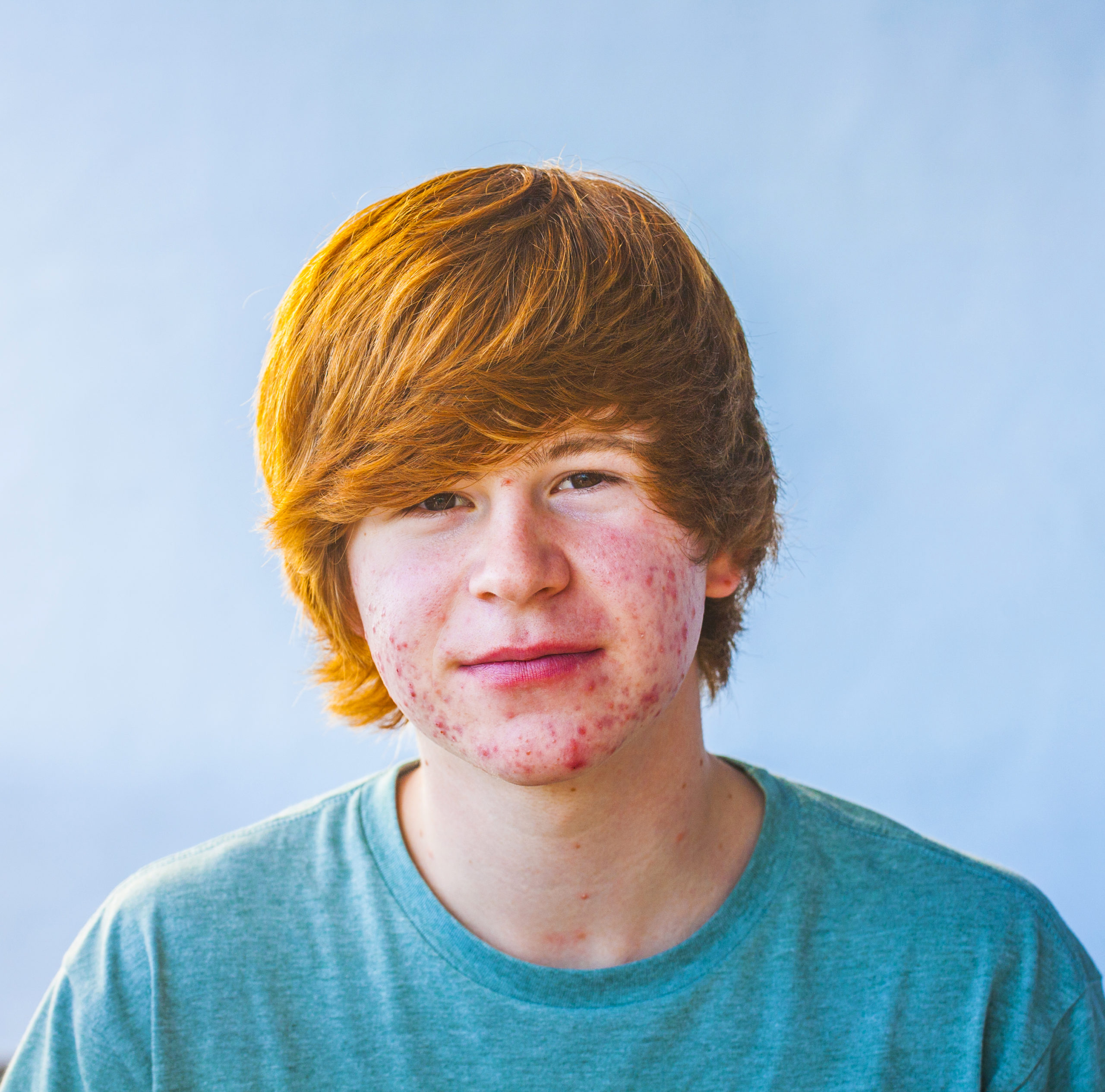 rid of acne Allen Taintor Dermatology