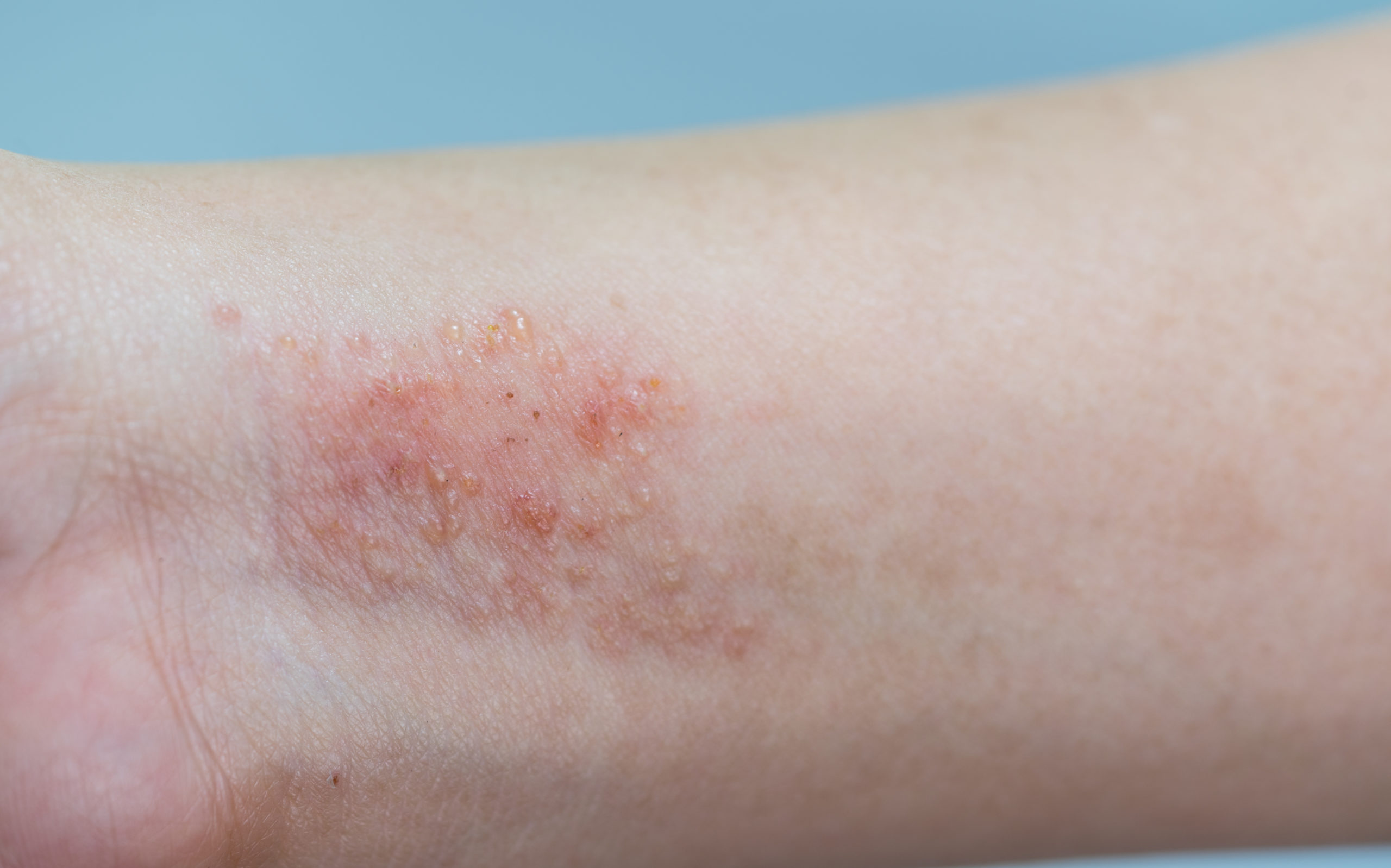how to treat eczema Allen Taintor Dermatology