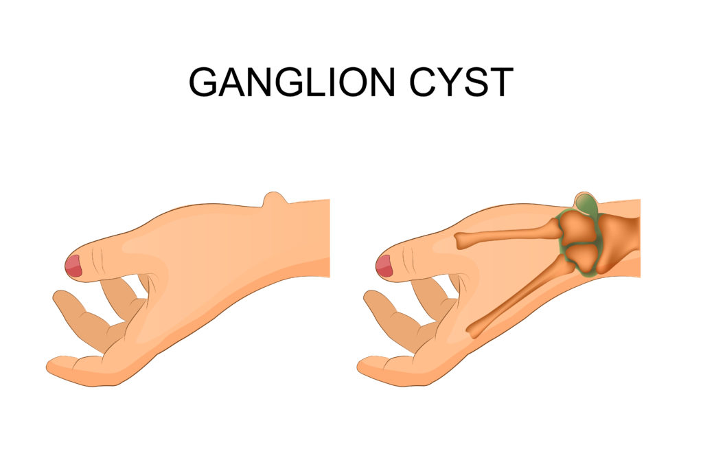 What Are Cysts and How to Treat Them?