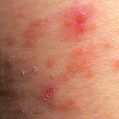 causes eczema