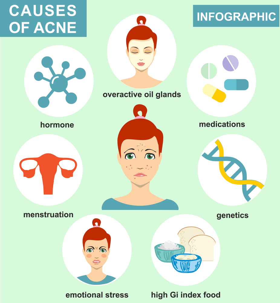 acne face map