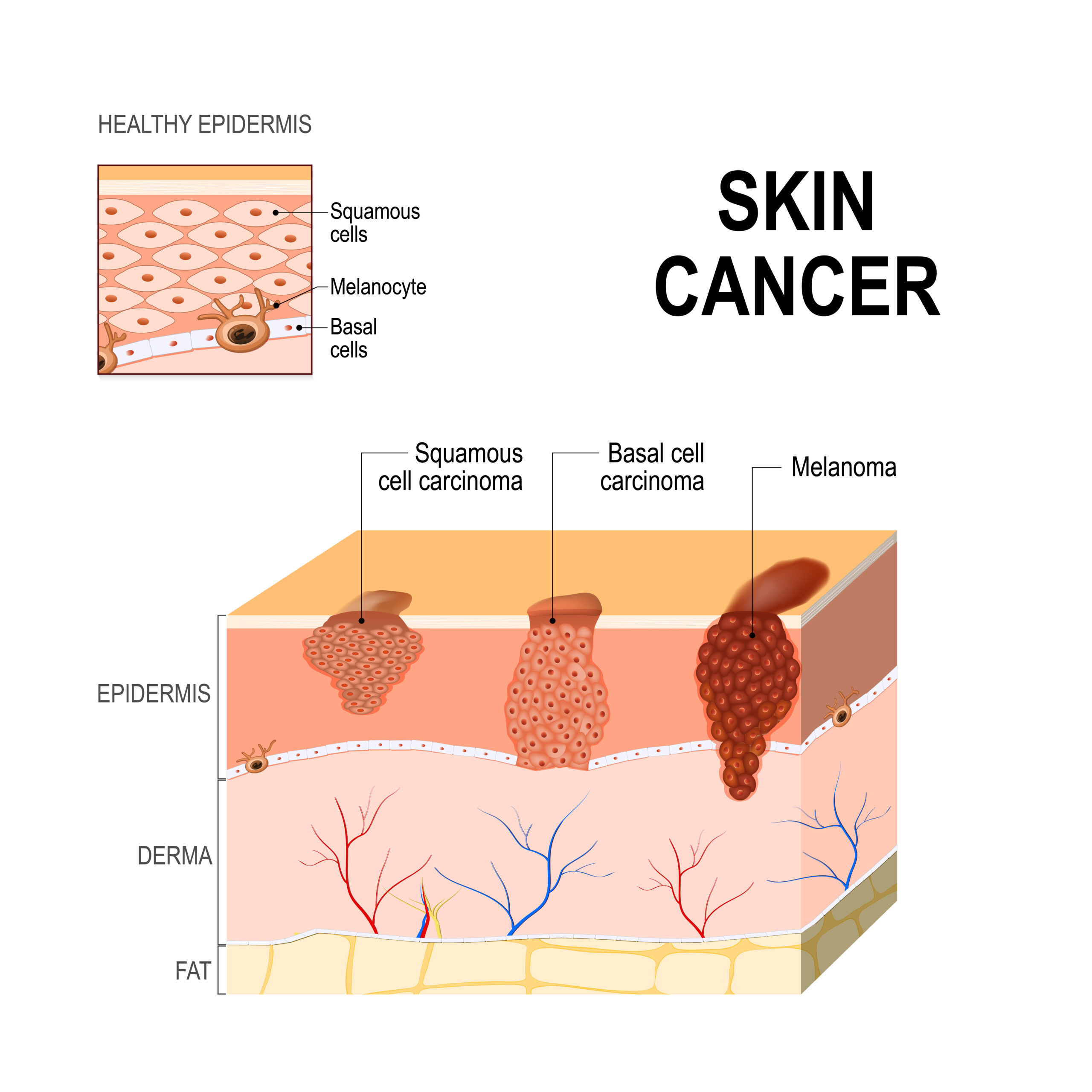 skin cancer on the face